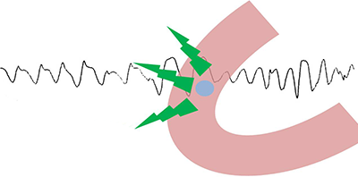 ECG polymorphic ventricular tachycardia, single focus, multiple port of exits sites