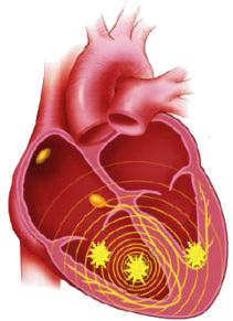 Polymorphic ventricular tachycardia, single focus, multiple exit sites