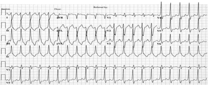 ECG Left Ventricular Outflow Tract (LVOT) Tachycardia, adenosin sensitive ventricular tachycardia