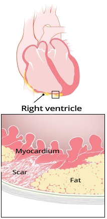 RVOT Ventricular Tachycardia - ECG book