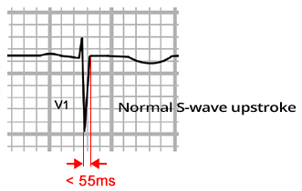 ECG normal S wave upstroke, sinus rhythm