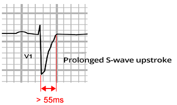 ECG prolonged S wave upstroke, from nadir of S wave, Arrhythmogenic Right Ventricular Cardiomyopathy, dysplasia (ARVC, ARVD)