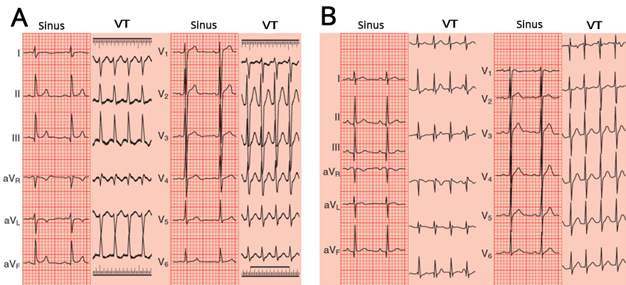 ECG narrow complex ventricular tachycardia, upper septal fascicular VT