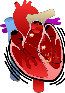 Fascicular ventricular tachycardia, RVOT-VT, LVOT-VT