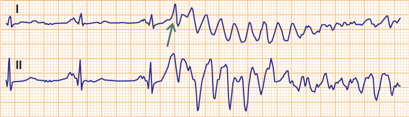 ECG sinus rhythm, Phenomenon R on T, ventricular fibrillation