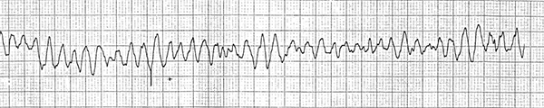 ECG ventricular fibrillation, Chaotic irregular deflections of varying amplitude