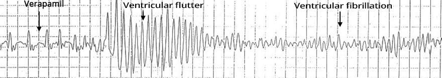 ECG supraventricular tachycardia (narrow complex tachycardia), administration of verapamil, Ventricular flutter, Ventricular fibrillation