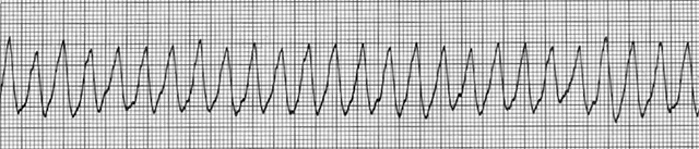 ECG ventricular flutter, Continuous Sine Wave