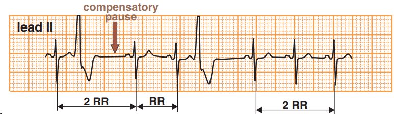 Premature Ventricular Complex - ECG book