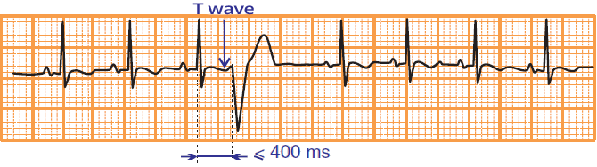 ECG phehomeno R on T, coupling interval, premature ventricular complex