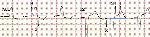 ECG premature ventricular complex, Appropriate discordance, full compensatory pause