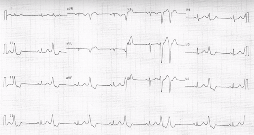 ECG premature ventricular complex localisation, heart base, and right ventriculi