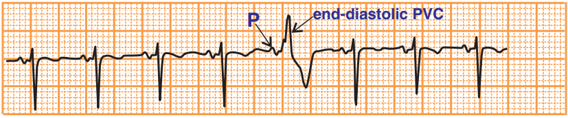 ECG end distolic premature ventricular complex, short PR interval