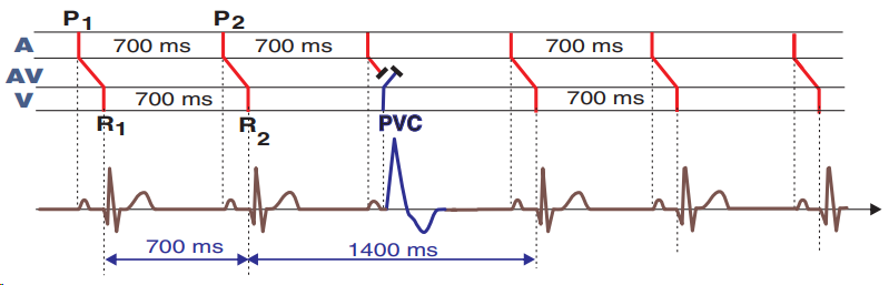 ECG laddergram, end diastolic premature ventricular complex, compensatory pause, short PR interval