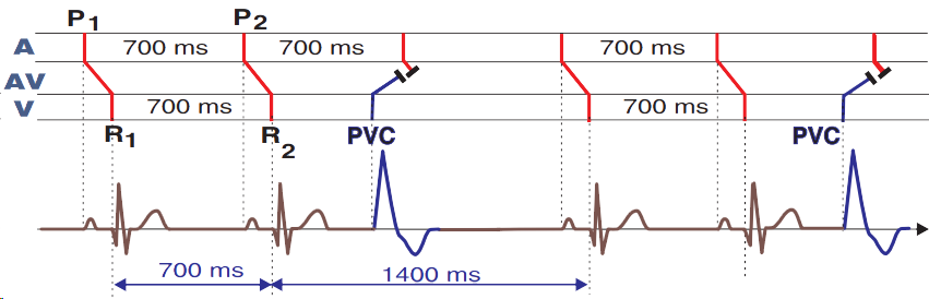 ECG laddergram, premature ventricular complex, fully compensatory pause, broad qrs, pp interval