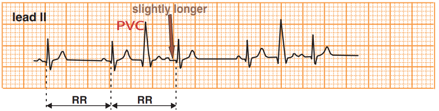 ECG interpolated premature ventricular complex, concealed conduction, sandwich extrasystole