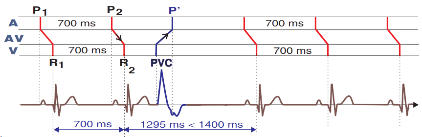 ECG laddergram, non-compensatory pause, premature ventricular complex