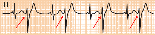 ECG premature ventricular complex (PVC) bigeminy - every other beat is a PVC