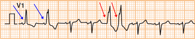 ECG premature ventricular complex (PVC) couplet - two consecutive PVCs