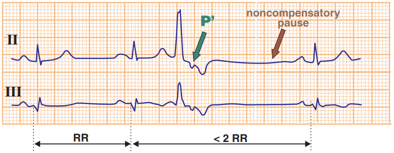 Premature Ventricular Complex - ECG book