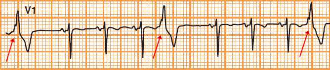 ECG premature ventricular complex (PVC) quadrigeminy — every fourth beat is a PVC