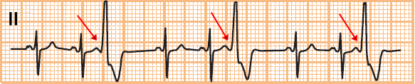 ECG premature ventricular complex (PVC) trigemini - every third beat is a PVC