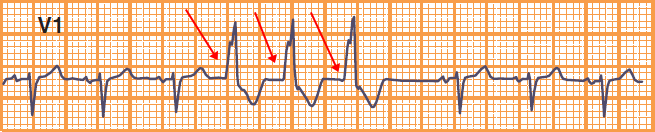 ECG premature ventricular complex (PVC) triplet, salva - three consecutive PVCs