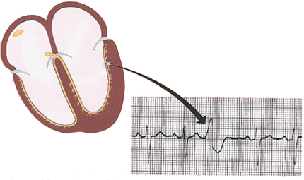 ECG ectopic focus depolarisation, and premature ventricular complex