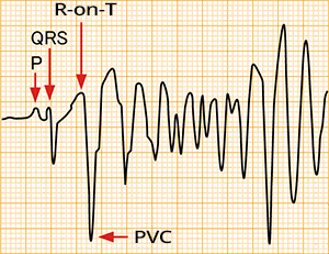 ECG R-on-T phenomenon, vulnerable period, Torsades de Pointes