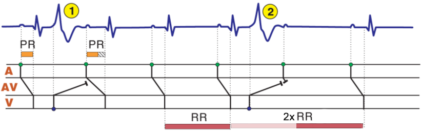 ECG laddergram, concealed conduction, sandwich extrasystole, Interpolated premature ventricular complex (PVC)