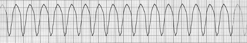 ECG sustained ventricular tachycardia, broad qrs complexes