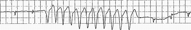 ECG non-sustained ventricular tachycardia, broad QRS