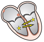 2 ectopic foci, multifocal premature ventricular complex