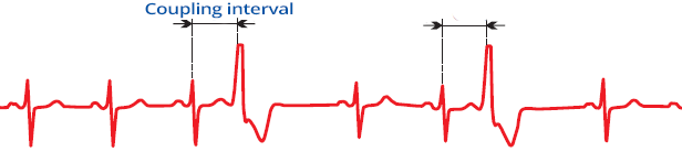 ECG unifocal premature ventricular complex, fixed coupling interval