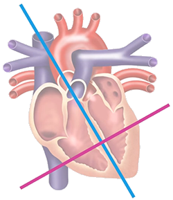 Localisation of premature ventricular complex, base, apex, left ventricle, right ventricle