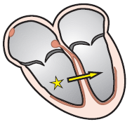 ventricular ectopic focus, and unifocal premature ventricular complex