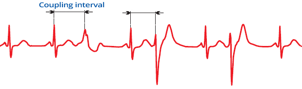 ECG multifocal premature ventricular complex, variable coupling interval, variable QRS complexes