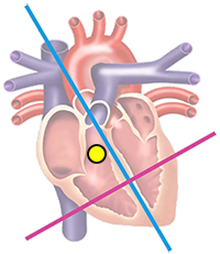 ventricular ectopic focus in right ventricle, heart base