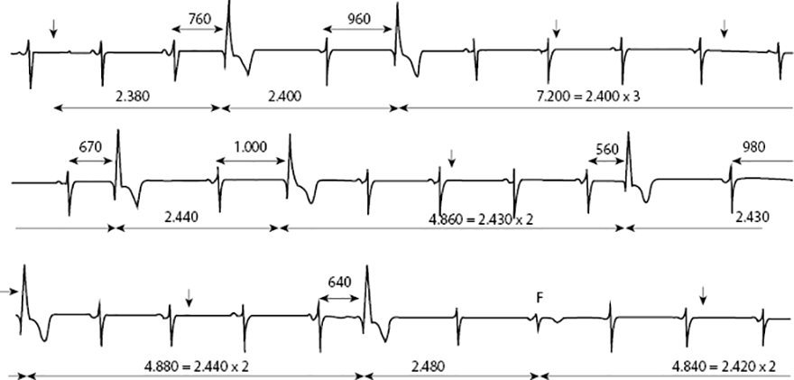 Ventricular parasystole, varying coupling interval, fusion compexes, interectopic intervals