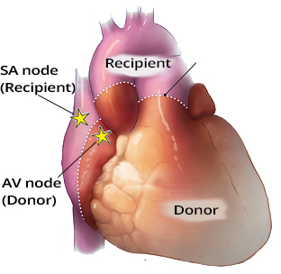 Atrial Parasystole after Heart Transplantation