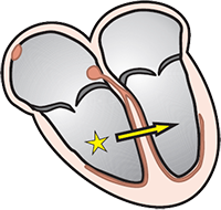 Ventricular rhythm, Idioventricular escape rhythm, ventricular ectopic focus