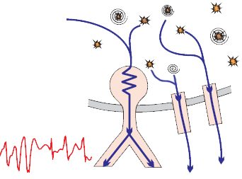 WPW syndrome, 2 accessory pathways