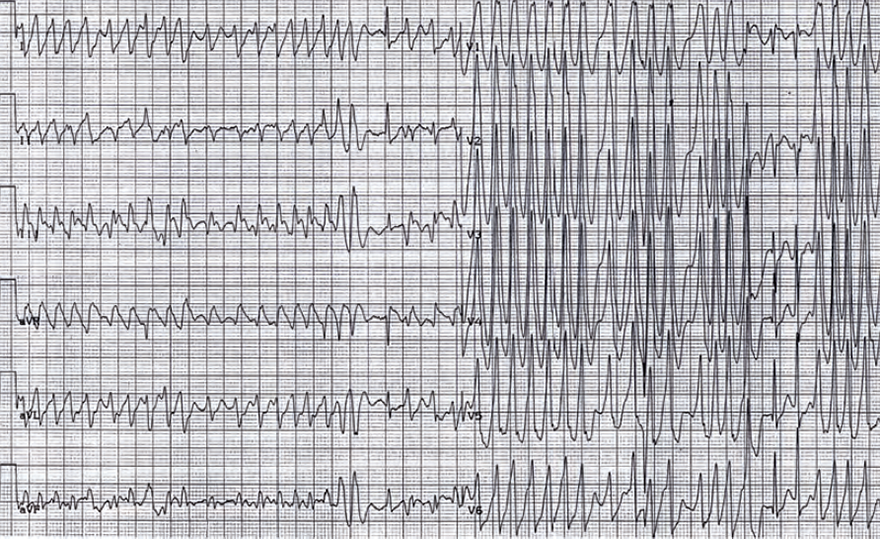 ECG WPW syndrome ventricular activation by 2 accessory pathways (posteroseptal and left posterior regions). Change axis in lead II 