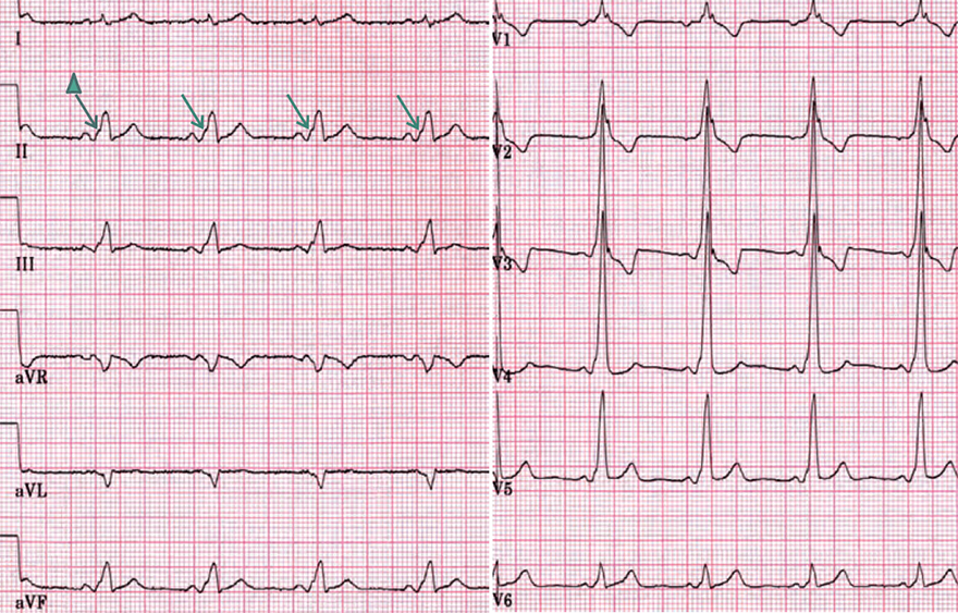 ECG wpw syndrome, type A, left-sided accessory pathway, delta wave