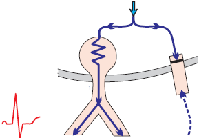 WPW syndrome, concealed accessory pathway