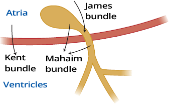 Pre-excitation syndrome, James bundle, Lown-Ganog-Levine (LGL) syndrome