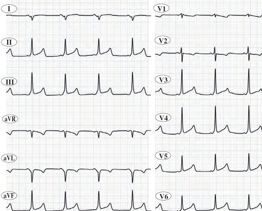 ECG wpw syndrome, left lateral accessory pathway (bundle of Kent)