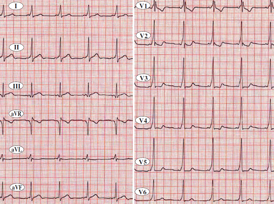 ECG WPW syndrome, left lateral accessory pathway anatomic location