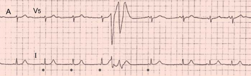 ECG couplet pvc, sinus rhythm