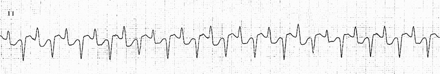 ECG Bidirectional ventricular tachycardia (BVT)